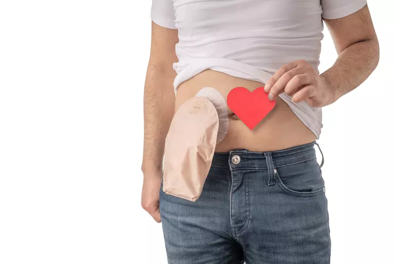 Paulo Cezar Martins propõe passe livre em transporte coletivo para pessoas ostomizadas 1 Entenda o que é ostomia